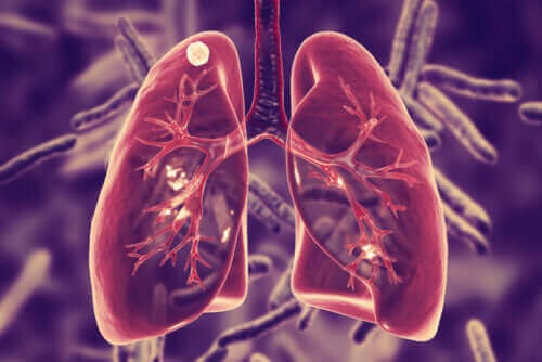 Τι είναι η πνευμονική φυματίωση και ποια τα συμπτώματά της;