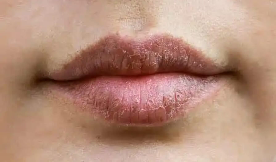 ξηρά χείλη