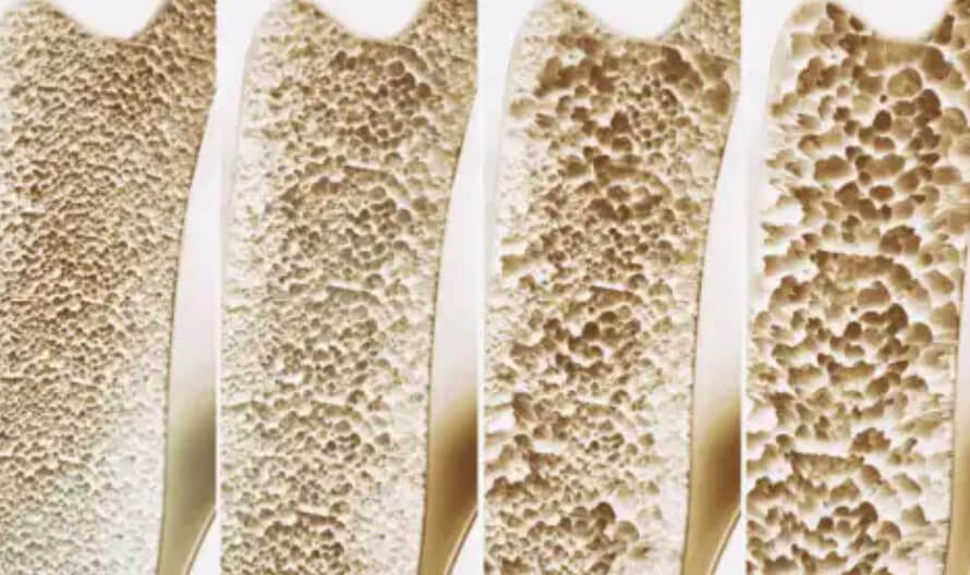 πυκνότητα οστών