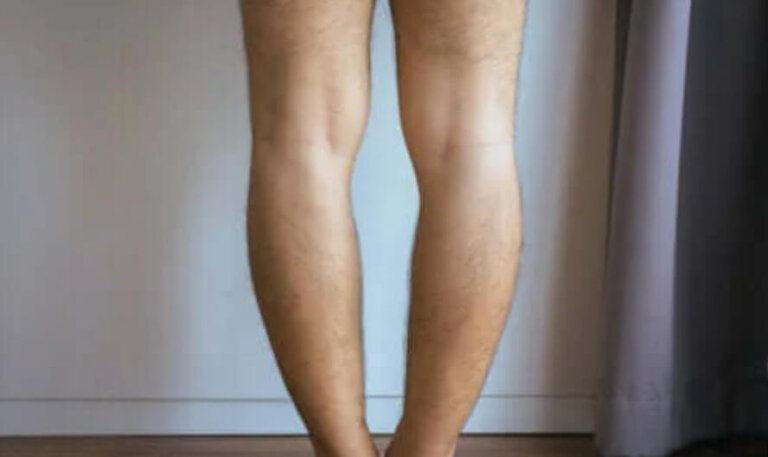 Genu Varum ή αλλιώς στραβά πόδια: Αιτίες και θεραπεία