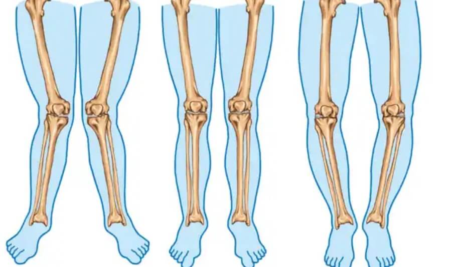 απεικόιση για στραβά πόδια