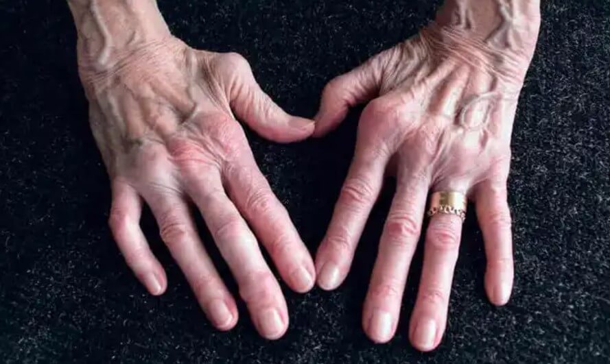 χέρια με αρθρίτιδα