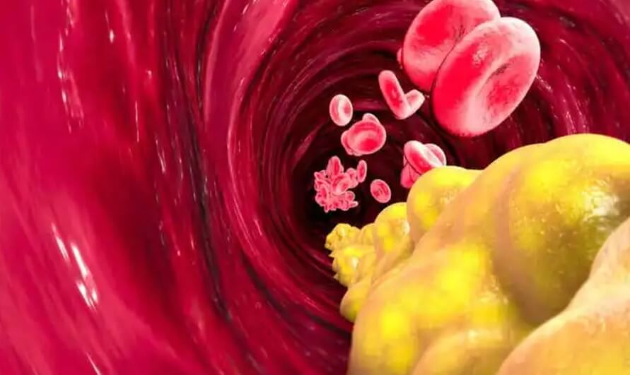 αρτηρίες γεμάτες