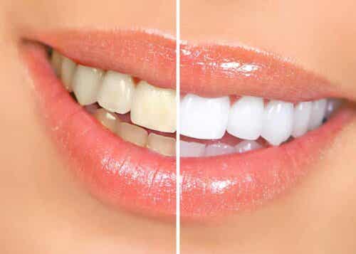 Σύγκριση κίτρινων και λευκών δοντιών