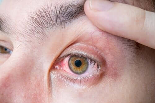 Οφθαλμικό μελάνωμα: συμπτώματα και αιτίες