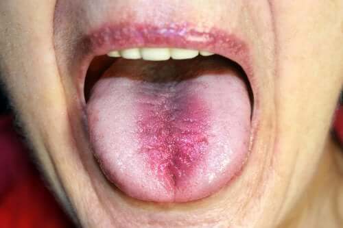 Σύνδρομο καυσαλγίας στόματος: αναγνώριση και θεραπεία