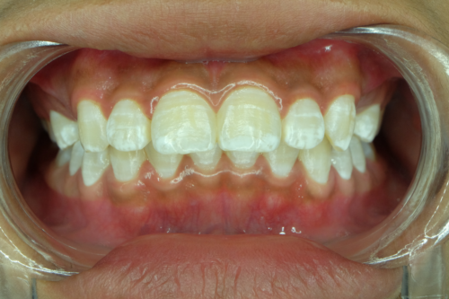 Λευκές κηλίδες στα δόντια: Γιατί εμφανίζονται;