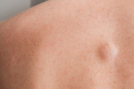 Ένα εξόγκωμα στην πλάτη: 7 πιθανές αιτίες