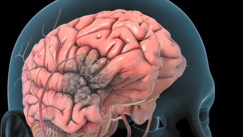 Θρόμβωση εγκεφαλικής αρτηρίας: Αιτίες, συμπτώματα και θεραπεία