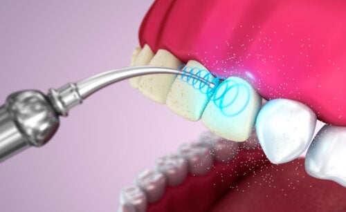 Καθαρισμός δοντιών με υπερήχους: Πλεονεκτήματα και μειονεκτήματα