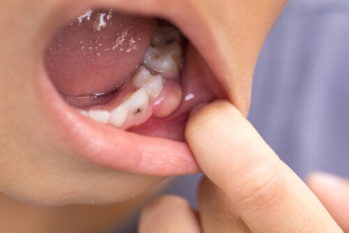 Συμπτώματα οδοντικής λοίμωξης που έχει εξαπλωθεί στο σώμα