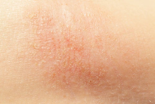 6 φανταστικές φυσικές θεραπείες για το ξηρό δέρμα