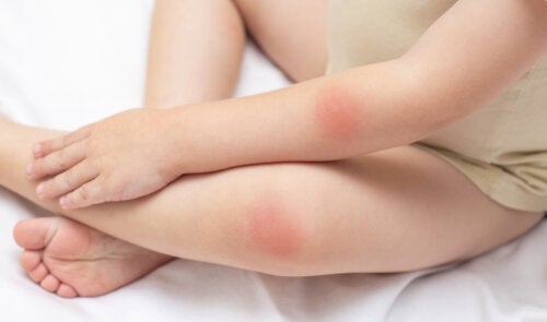 Κόκκινες κηλίδες στο δέρμα: 25 πιθανές αιτίες και θεραπείες