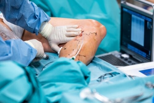 Χειρουργική επέμβαση Endolaser για τους κιρσούς: Τι είναι;